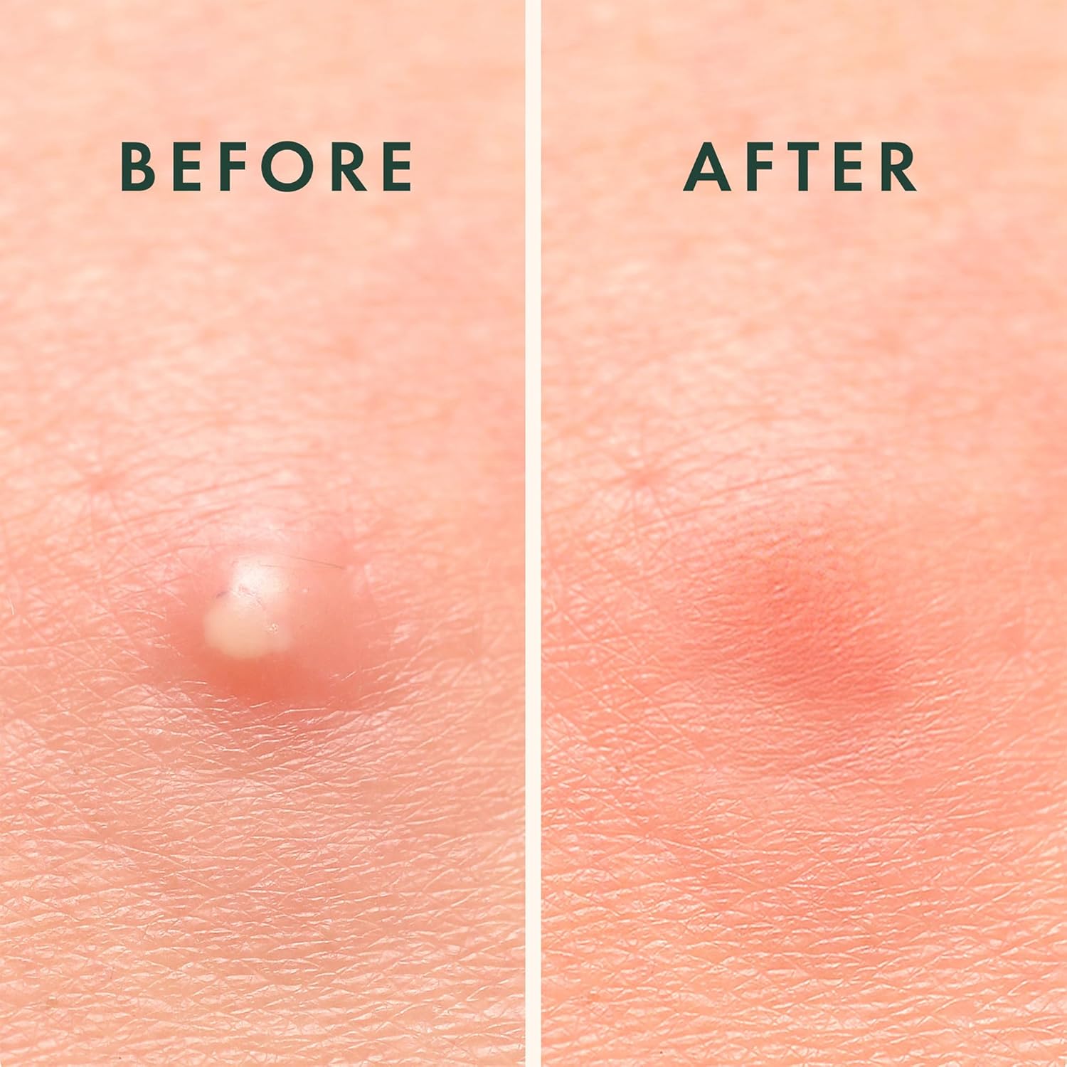 Rael Acne Pimple Patches